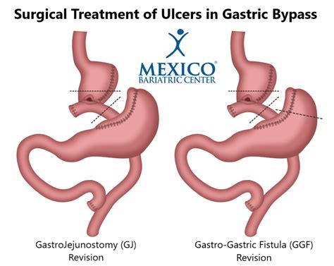 Signs and Symptoms of Ulcers After Gastric Bypass - Mexico Bariatric Center