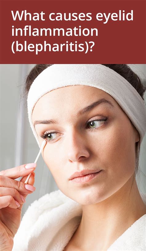 How to Get Rid of Sore, Red Eyelids (Blepharitis) | Blepharitis ...
