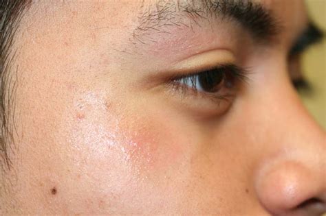 Mild Atopic Dermatitis Face