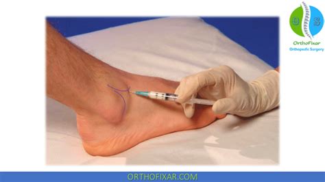 Ankle Steroid Injection | OrthoFixar 2024