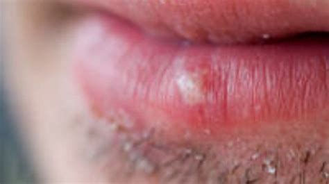 Sunburn On Lips Blisters | Lipstutorial.org