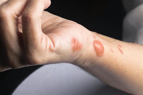 Burn scars: Treatment, removal, and prevention