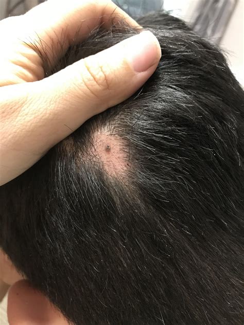 What can this be on my scalp? Melanoma? Benign? Caused balding. Was big and filled with puss ...