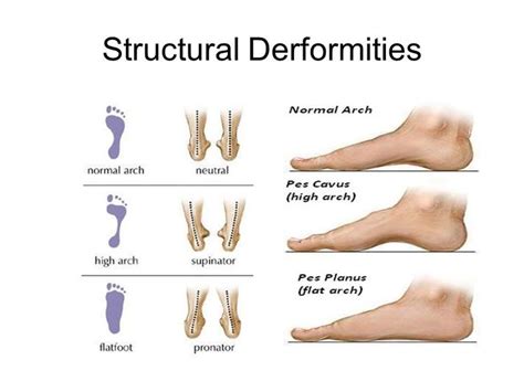 Pes planus, Flat feet