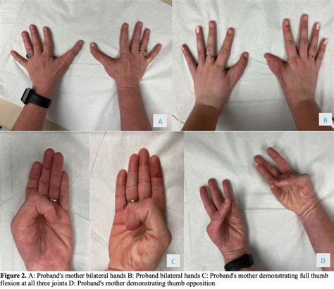 AAHS - Multigenerational Triphalangeal Thumb: Suspicion for a New Dominantly-Inherited Disorder ...