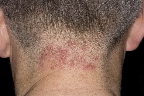 Pityrosporum Folliculitis Scalp