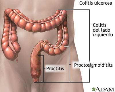 Colitis ulcerativa: MedlinePlus enciclopedia médica illustración