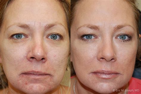 Eric M. Joseph, MD | Botox Before & After: Frown Line Reduction