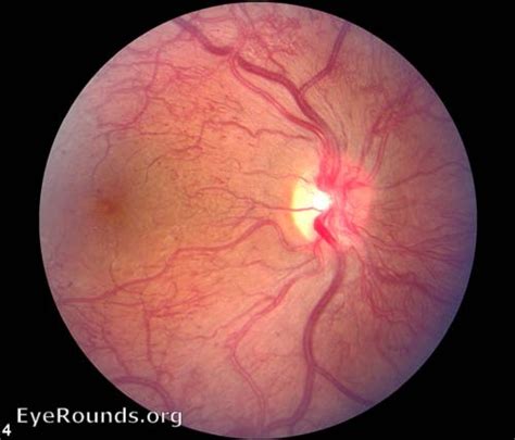 Atlas Entry - Proliferative diabetic retinopathy (PDR)