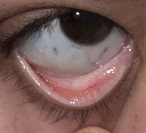 Pale eyelids? : r/Anemic