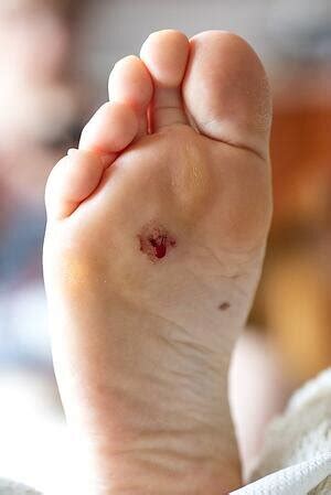 AMPUTATION: THE WORST-CASE SCENARIO FOR A PATIENT SUFFERING FROM DIABETIC FOOT PROBLEMS — River ...