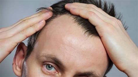 Alopecia eyebrows: Top 3 things and all you need to know