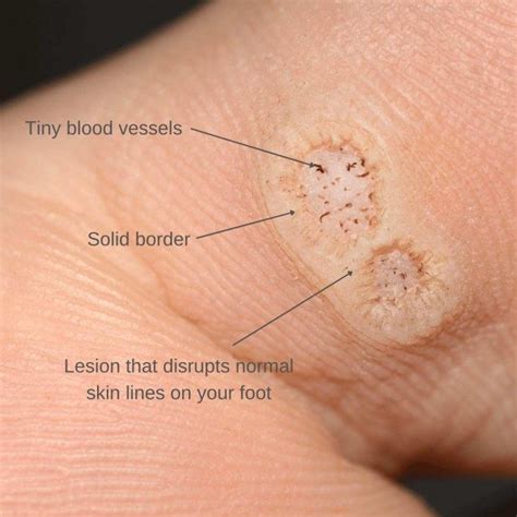 Plantar Warts: Causes, Symptoms & Treatment | The Feet People Podiatry