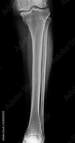 Lower leg xray , x-ray image of leg front view , xray of normal leg bone in adult - Buy this ...