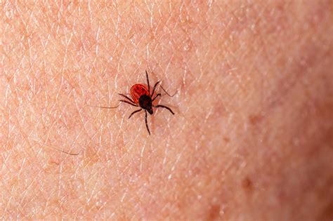 Bug Bites and Stings: How To Treat Them And When To See A Doctor ...