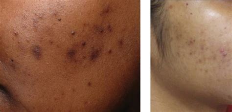 Post Inflammatory Hyperpigmentation Reddit : Pigmentation Dermal Skin ...