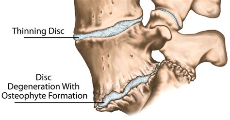 Bone Spurs of the Spine – What Causes Them and How Can They Be Treated? - Patrick Senatus, M.D.