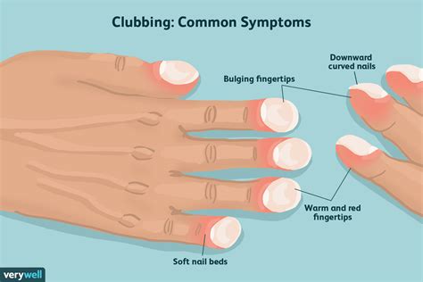 Clubbed Fingers and Nails: Causes and What They Look Like - EU-Vietnam ...