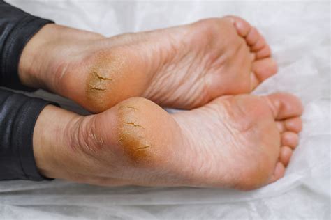 Foot Fissures – Symptoms, Causes, Treatment, Prevention & Remedies