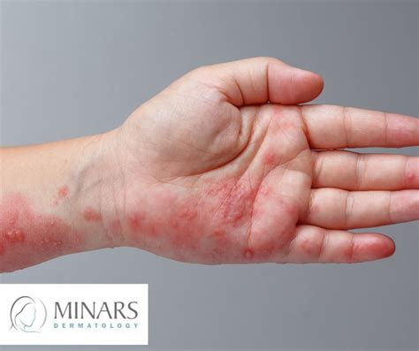 Effective Shingles Treatment Near You in Hollywood - Help With Rashes & Shingles - Trusted ...