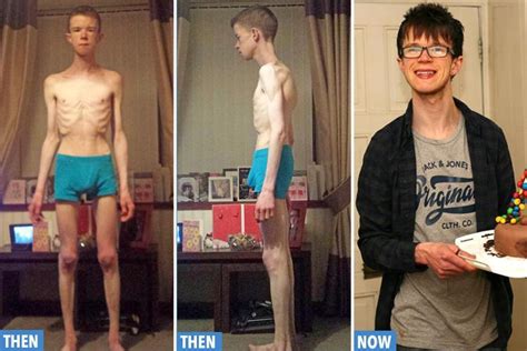 Anorexic male student who was 'close to death' after surviving on 1,200 calories a day says ...