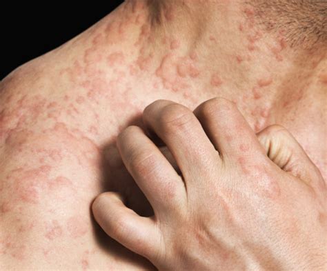 Acute urticaria in children and adults: causes and symptoms of the ...