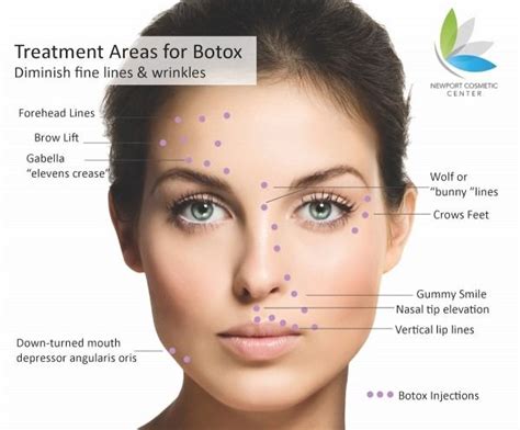 Botox Injection Sites Face Diagram | Botox injection sites, Botox, Botox injections