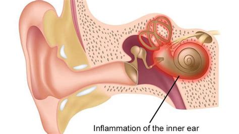 Signs And Symptoms of Inner Ear Infection – Entirely Health