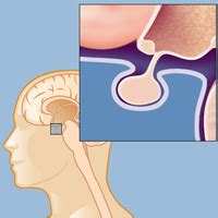 A Triple Dose of Brain Tumors | Brain & Spine Center