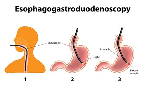 Gastrointestinal Endoscopy - CPM Advanced Surgical Specialists