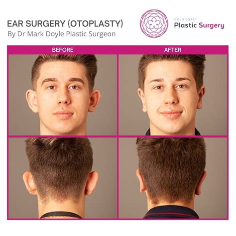 Ear Surgery (Otoplasty) Gold Coast & Brisbane | Plastic Surgeon