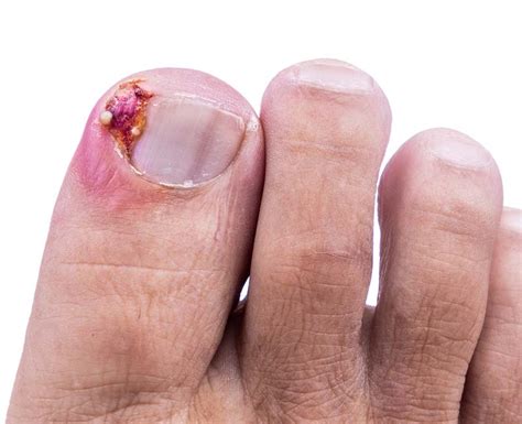 Ingrown Toenails: Signs, Causes, Treatment & Prevention