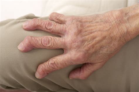 Arthritis Mutilans: Symptoms, Causes, Diagnosis, and Treatment