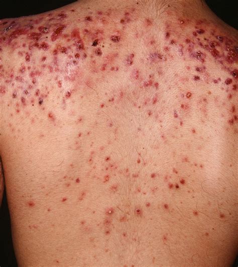 Back Acne Causes and Best Treatment to Get Rid of Back Acne and Scars