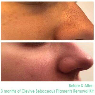 The Sebaceous Filaments Removal Kit – Clevive