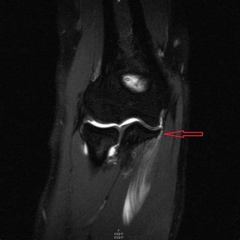 right elbow Mri with contrast showing complete tear of the UCL... | Download Scientific Diagram