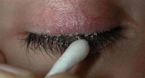 How to Get Rid of Eyelash Dandruff: 10 Most Effective Solutions