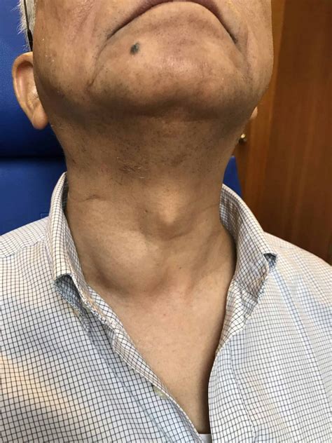 Dr. Dennis Chua’s Complete Guide to Neck Lump issues in Singapore - DrDennisChua.com