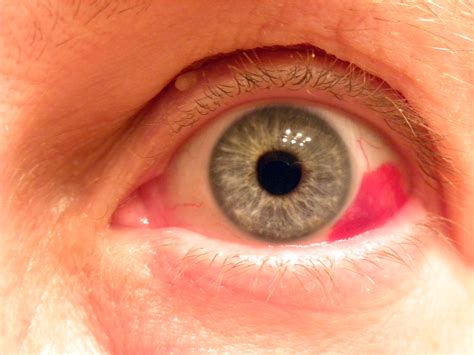 Painless Red Eye | AAFP
