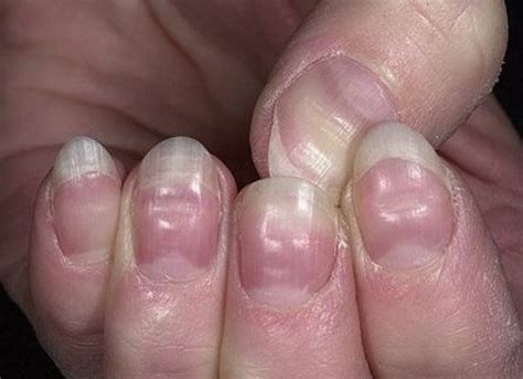 15 Health WARNINGS Your Fingernails Are Sending