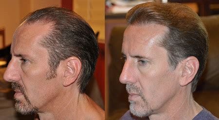 Follicular Unit Hair Transplantation, follicular Units, Hair Restoration, Walnut Creek, San Jose ...