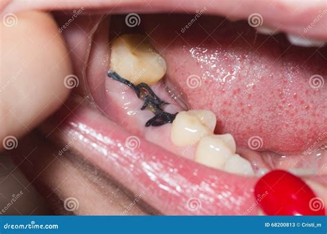 Stitches After Dental Extraction Royalty-Free Stock Photo | CartoonDealer.com #32450121