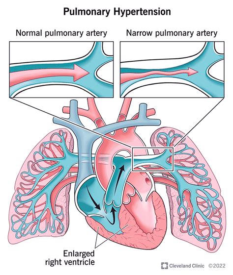 Pulmonary Hypertension: Symptoms, Treatment