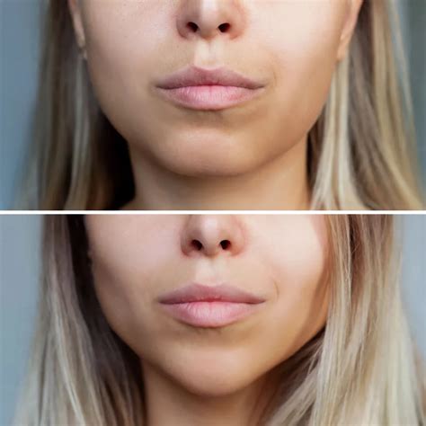 Sculptra Jawline Before and After Use Transformations