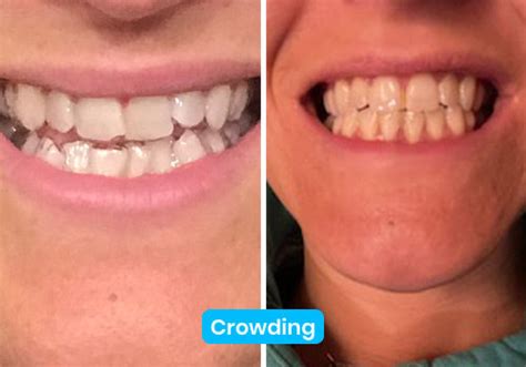 ALIGNERCO Before & After Clear Aligners Results & Reviews