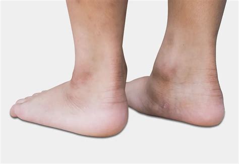 Flat Foot in Kids: Types, Causes, Signs & Treatment