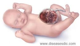 Beckwith-wiedemann syndrome (bws): Causes, Complications, Risks and Treatment