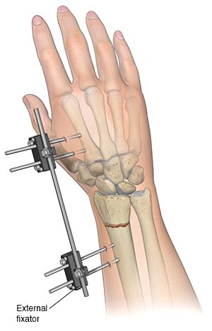 Treating Wrist Fractures