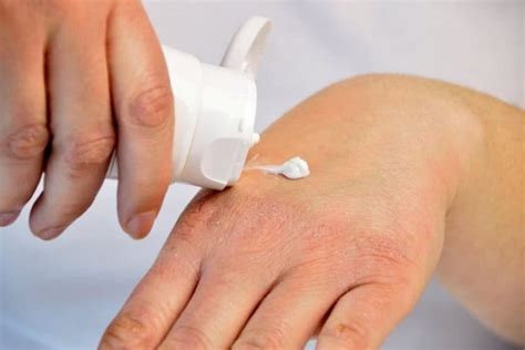 Calamine Lotion for Eczema - Is it a Good Treatment? - Skin Care Geeks