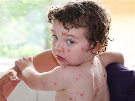 Start Of Chicken Pox On Babies - Goimages 411